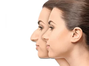 هزینه عمل بینی استخوانی