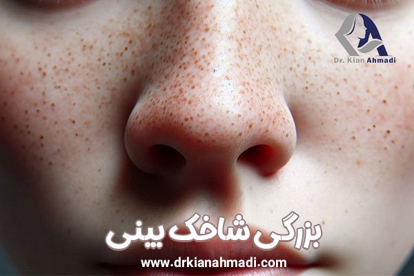 بزرگی شاخک بینی - دکتر کیان احمدی