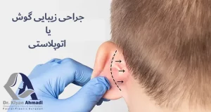 اتوپلاستی