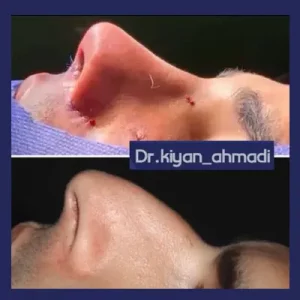 بهترین جراح بینی بروجرد - دکتر کیان احمدی