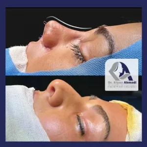 بهترین جراح بینی بروجرد - دکتر کیان احمدی