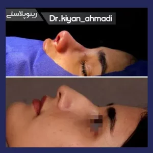 بهترین جراح بینی بروجرد - دکتر کیان احمدی