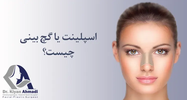 گچ بینی چیست