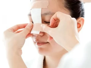 اسپلینت بینی چیست