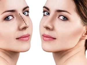 جراحی قوز بینی