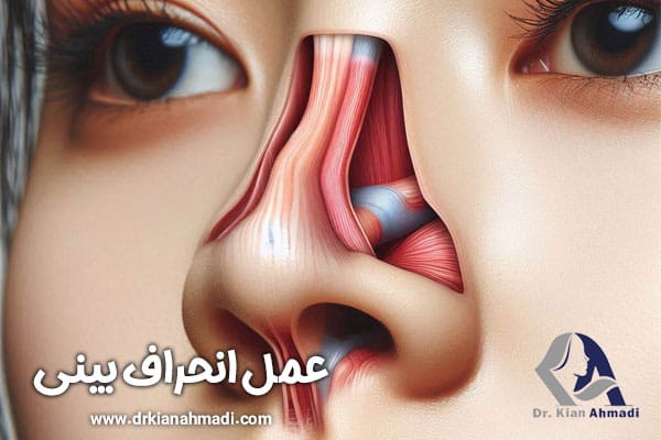 عمل انحراف بینی + دکتر کیان احمدی