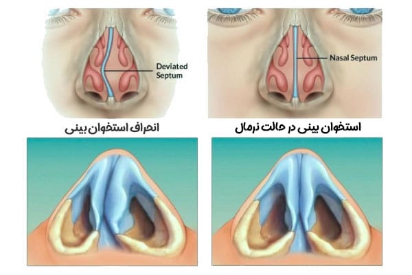 عمل انحراف بینی + دکتر کیان احمدی