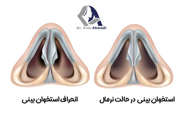 عمل انحراف بینی + دکتر کیان احمدی