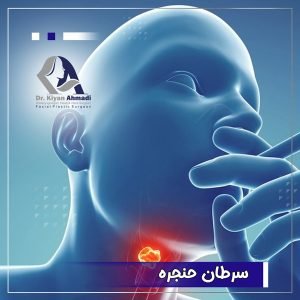 سرطان حنجره و علت آن - دکتر کیان احمدی