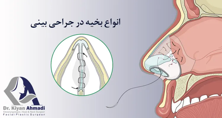 بخیه در جراحی بینی