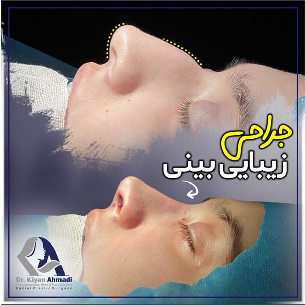 جراح بینی بروجرد - دکتر کیان احمدی