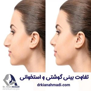 تفاوت بینی گوشتی و استخوانی - https://drkianahmadi.com/