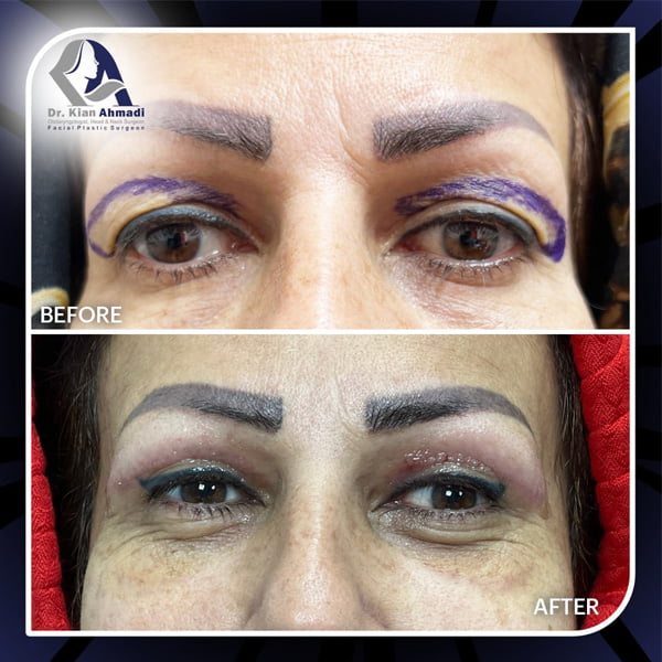 جراحی پلک در بروجرد - دکتر کیان احمدی