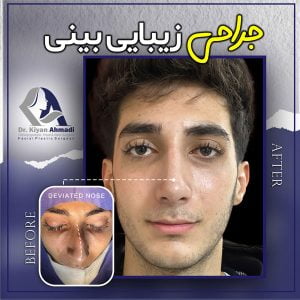 بهترین جراح بینی در بروجرد - دکتر کیان احمدی
