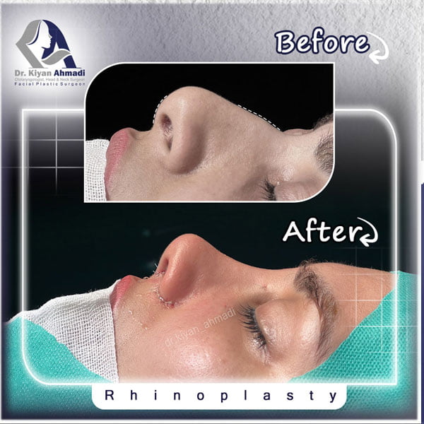 بهترین جراح بینی در بروجرد - دکتر کیان احمدی