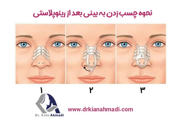 چسب زدن به بینی + دکتر کیان احمدی