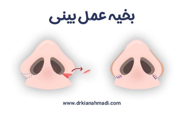 بخیه عمل بینی+ دکتر کیان احمدی