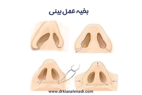بخیه عمل بینی+ دکتر کیان احمدی