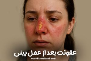 عفونت بعد از عمل بینی + دکتر کیان احمدی
